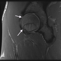 Figure 2 for case Hip Plica